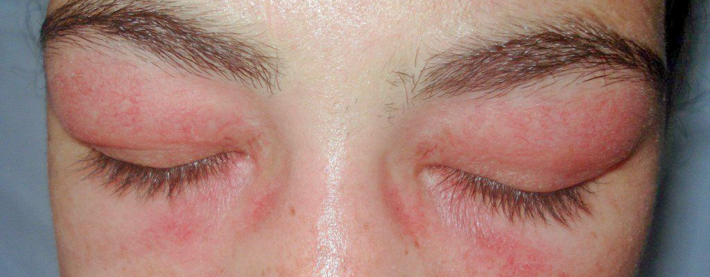 Δερματομυοσίτιδα στα μάτια