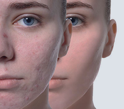 Πρόσωπο πριν και μετά τη θεραπεία για ουλές ακμής
